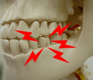 インプラント歯周炎の説明